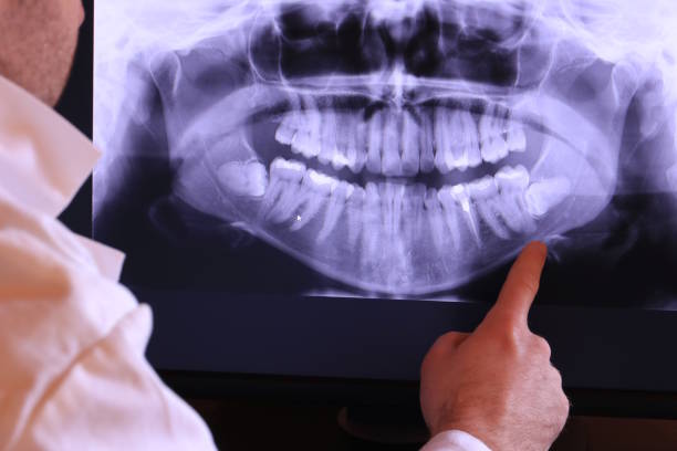 Best Knocked-Out Tooth (Avulsed Tooth) Treatment in Osceola, IN